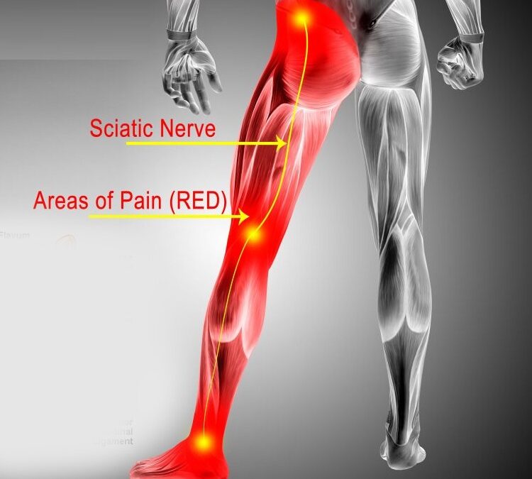 chiropractic treatment for sciatica