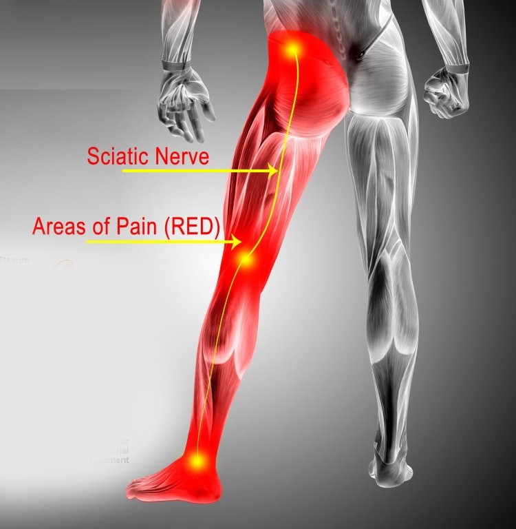 chiropractic treatment for sciatica