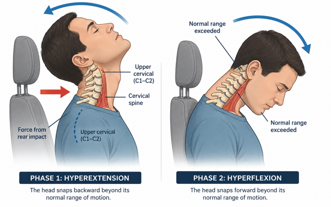 Chiropractor for Whiplash and Neck Injury Recovery
